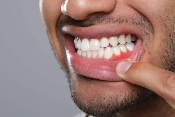 Gum diseases may affect more than teeth: How poor oral health raises stroke risk; key tips to protect oral and brain health |