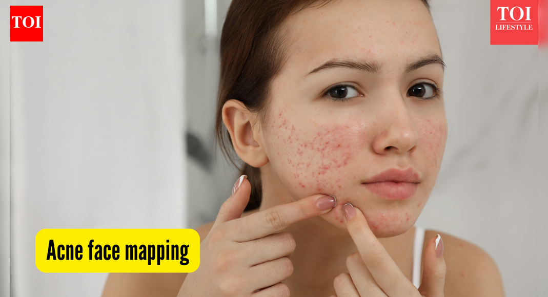 Acne mapping: What your breakout patterns reveal about skin, health, and habits