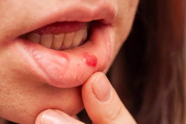 Mouth ulcers may signal hidden diseases: Health conditions they are linked to, who is at risk, and prevention tips |