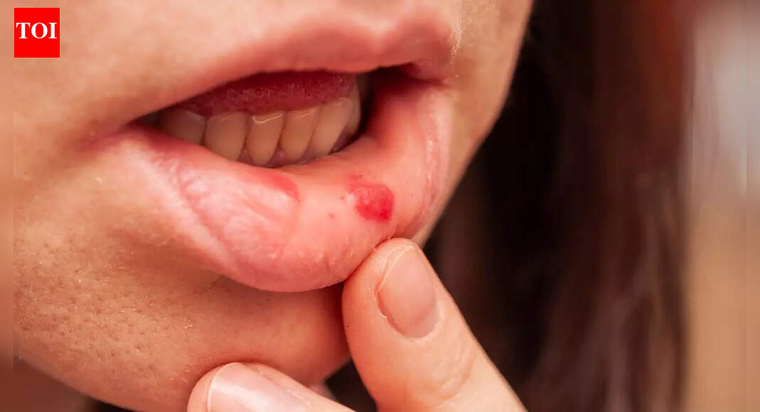 Mouth ulcers may signal hidden diseases: Health conditions they are linked to, who is at risk, and prevention tips |