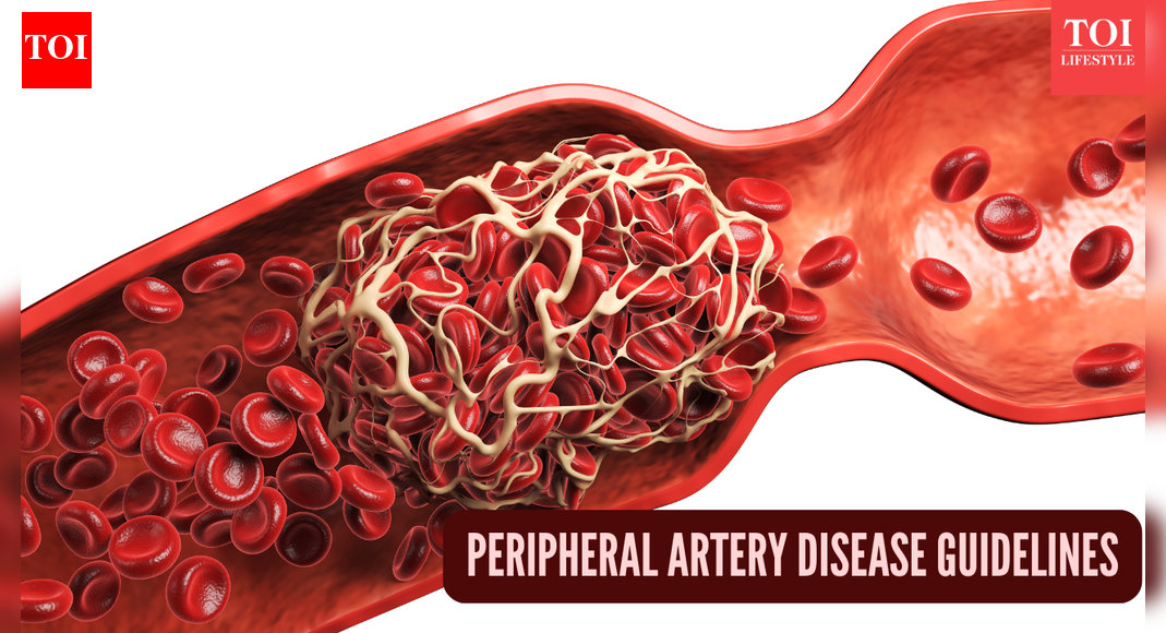 Cleveland Clinic helps shape new guidelines for peripheral artery disease care |