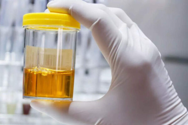 Foods and drinks that can make urine cloudy: Diseases and health conditions linked to it |