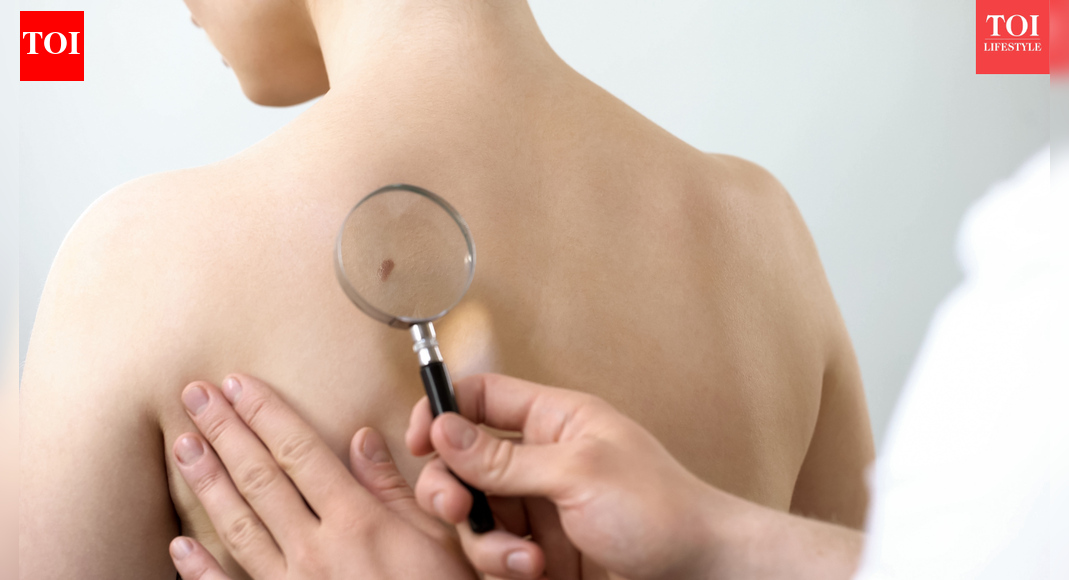 Skin Cancer: Judge Frank Caprio’s son David Caprio warns about skin cancer after an alarming dermatologist visit |