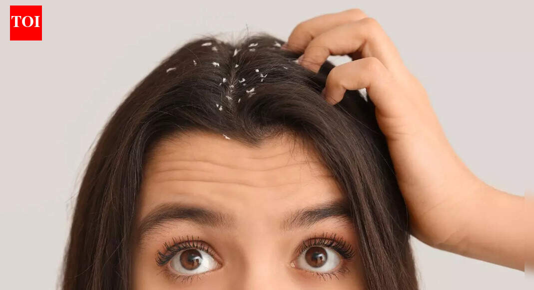 Dandruff is more than just poor hygiene; know what your scalp is telling you |