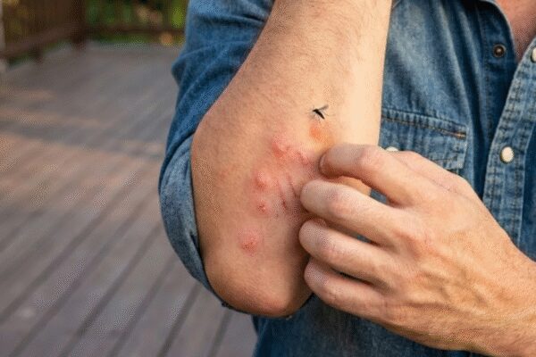 Why mosquitoes bite you more: The surprising science behind being a ‘mosquito magnet’ |