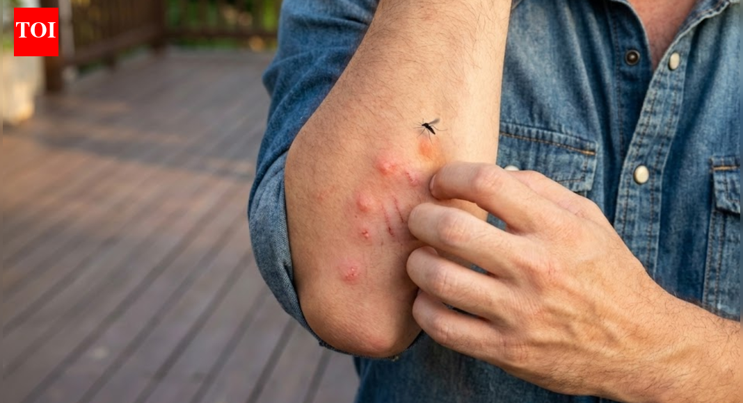 Why mosquitoes bite you more: The surprising science behind being a ‘mosquito magnet’ |
