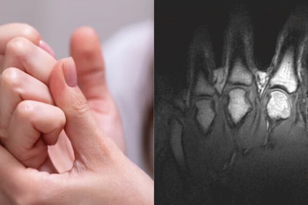 Does cracking your knuckles make them bigger? Scientists finally settle long-standing myth