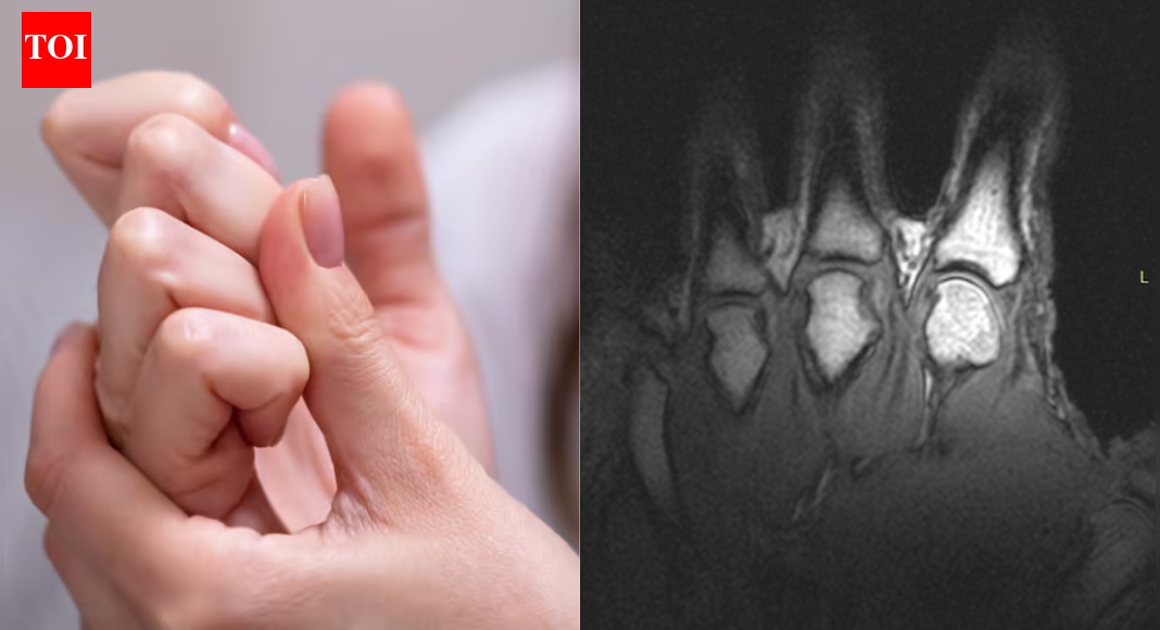 Does cracking your knuckles make them bigger? Scientists finally settle long-standing myth