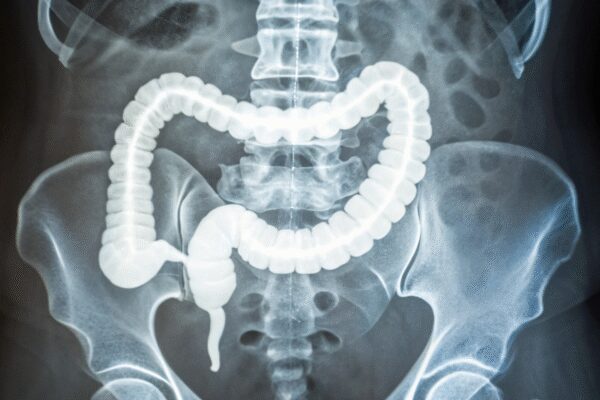 Why a stiffer colon is raising alarms as colorectal cancer appears earlier: How to identify it
