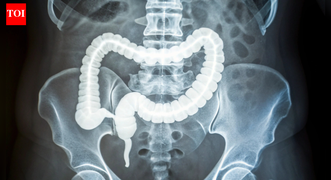 Why a stiffer colon is raising alarms as colorectal cancer appears earlier: How to identify it