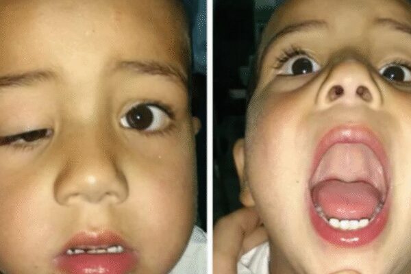 What is Marcus Gunn syndrome, in which the eyelid moves with the jaw: Understanding risks and inheritance