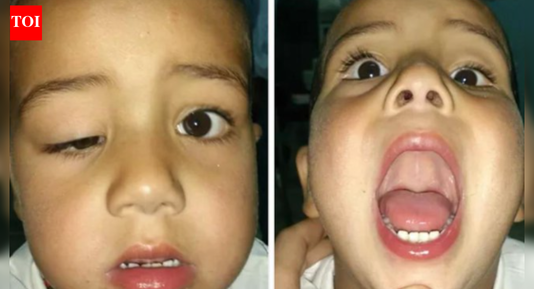 What is Marcus Gunn syndrome, in which the eyelid moves with the jaw: Understanding risks and inheritance