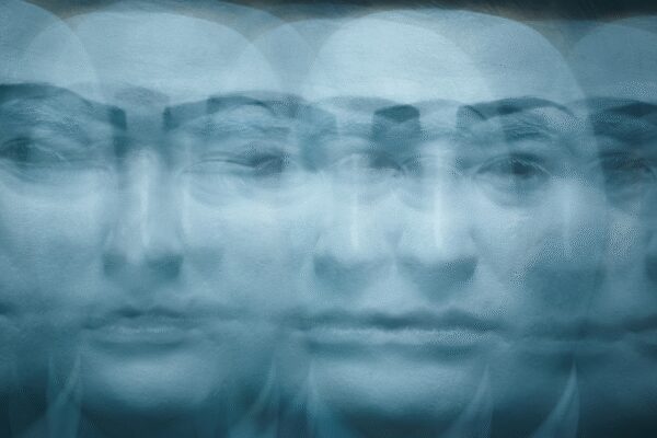 When the brain sees faces everywhere: How visual snow syndrome amplifies pareidolia