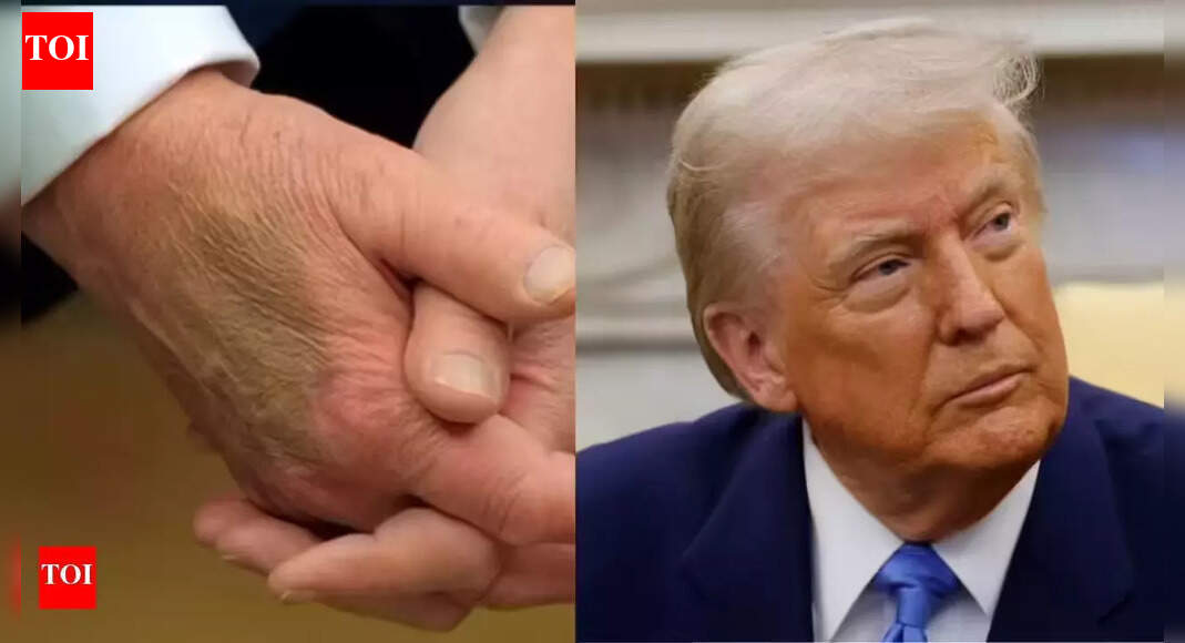 Compression socks, aspirin and makeup: Trump admits concealing visible signs of health problems | World News