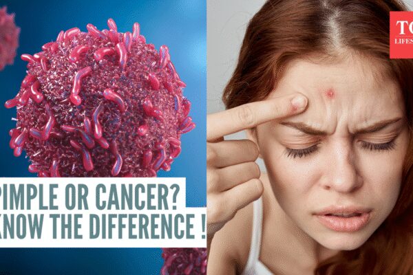 Basal cell skin cancer: Dermatologist explains how it can be mistaken for a harmless pimple and shares how to identify the difference |
