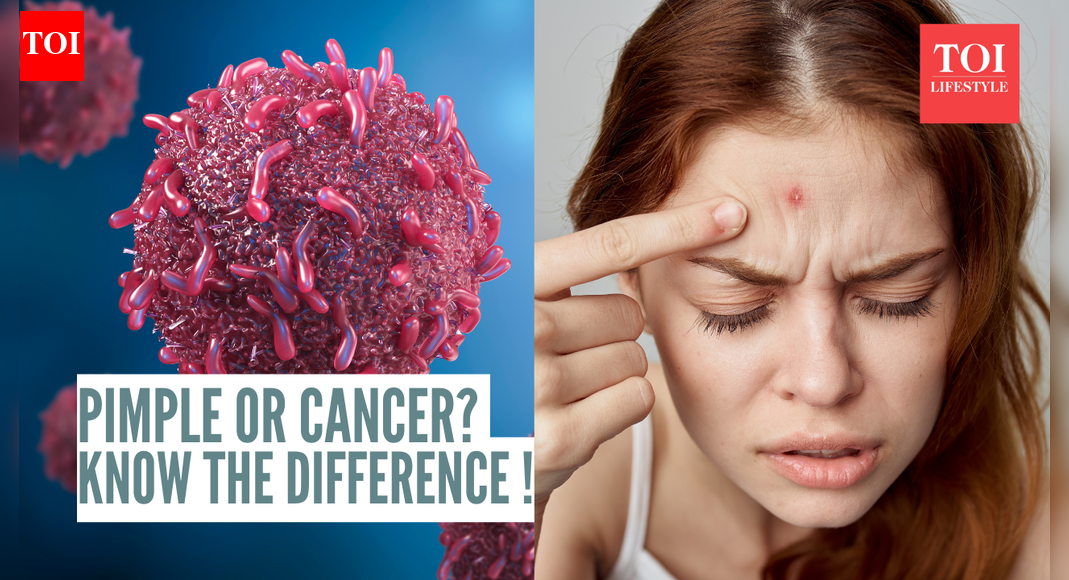 Basal cell skin cancer: Dermatologist explains how it can be mistaken for a harmless pimple and shares how to identify the difference |
