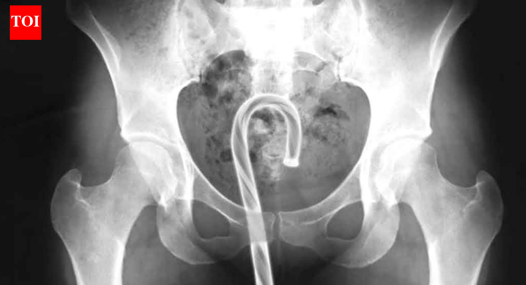 US government releases list of unusual objects surgically removed from people’s rectums in 2025 |