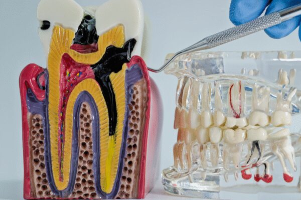 When a routine tooth extraction triggers a sight-threatening eye emergency days later