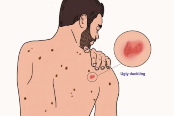 Ugly duckling sign for melanoma: Symptoms, studies, and self-check tips