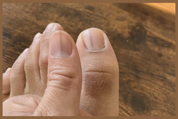 Faint black lines on nails: Harmless or sign of aggressive skin cancer? Reddit post goes viral |