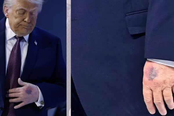Row over Trump’s hand bruise in Davos and ‘missing medical records’: ‘Two years of coverage of Biden’s health…’