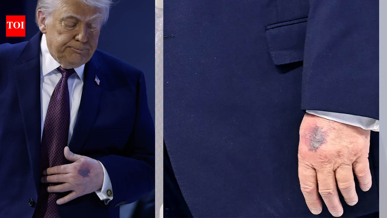 Row over Trump’s hand bruise in Davos and ‘missing medical records’: ‘Two years of coverage of Biden’s health…’