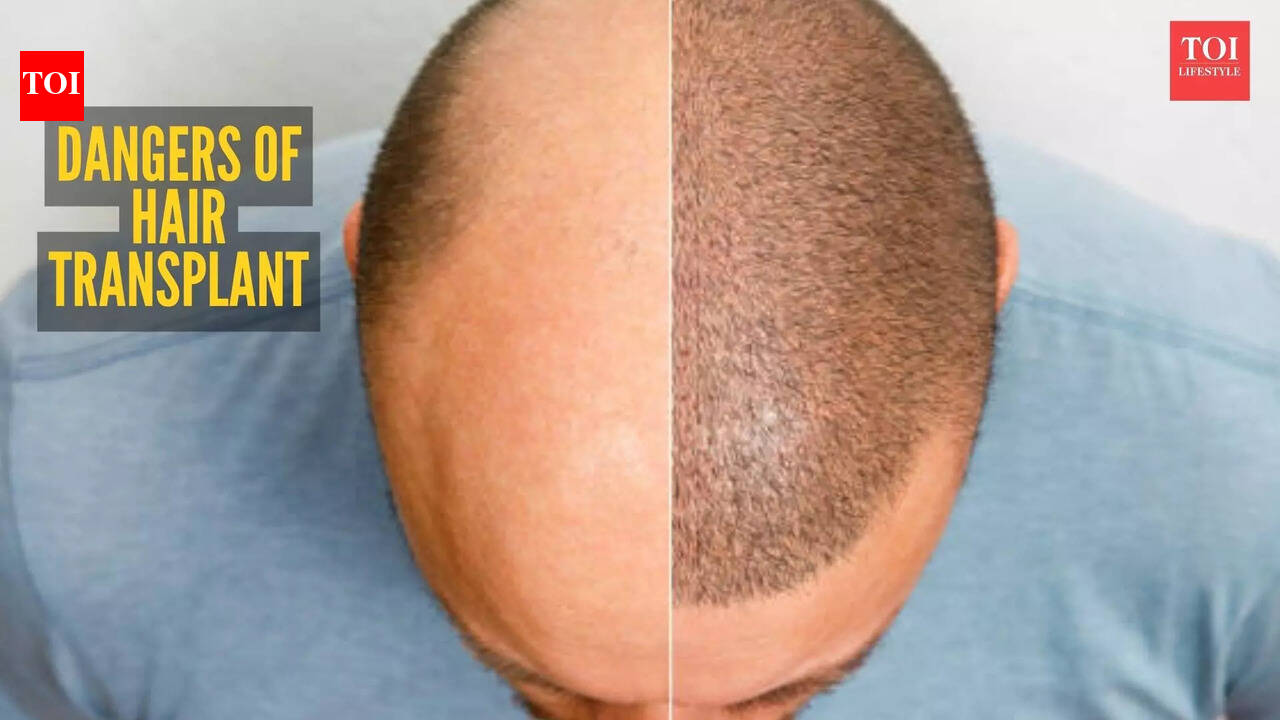5 possible side effects of a hair transplant you should know about before booking one
