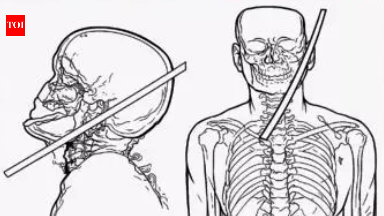 Man lives after rod pierces neck, narrowly misses brain and spine in Gurgaon; no neurological deficits | Gurgaon News