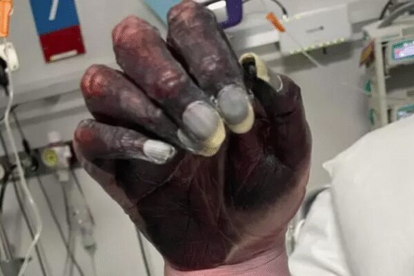 Mother dies after arm amputation as doctors dismiss blackened hand as ‘newspaper ink’ |
