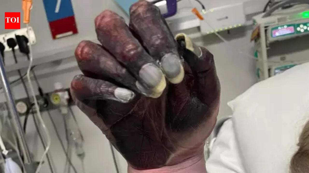 Mother dies after arm amputation as doctors dismiss blackened hand as ‘newspaper ink’ |