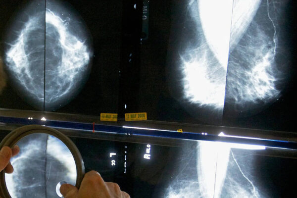 Pandemic disruptions to health care worsened cancer survival, study suggests